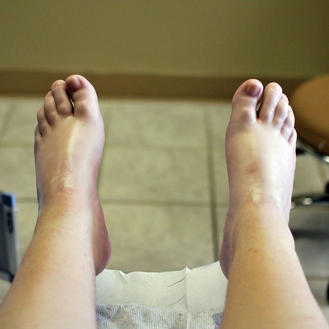 Warm Wax Treatment – Nenagh Footcare Clinic